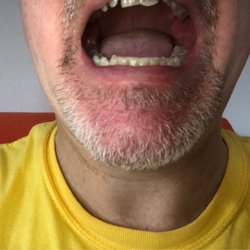 Town & Country Family Dental - Bottom 4 front teeth all were chipped now filled and even