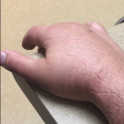 Wellington Orthopaedic & Sports Medicine - Here is my hand Wednesday afternoon. It's been broken for 4 days now.