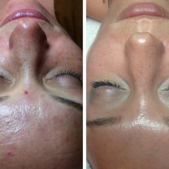 Melted Brow Bar and Skincare - Chemical Peel treatments before and after - Skin Care Near Me - Bend, Oregon Melted Brow Bar and Skincare - Chemical Peel treatments before and after - Skin Care Near Me - Bend, Oregon