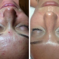 Chemical Peel treatments before and after