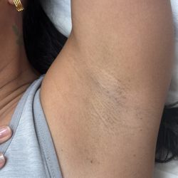 Davi Aesthetics - Mariam is a miracle worker. Being a woman of color, I had very dark armpits. Amazing results!