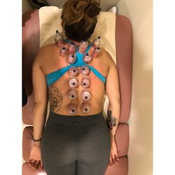 Cupping for myofascial relief.