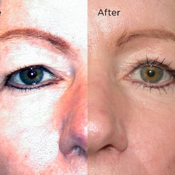 RevivaMed Plastic Surgery - Brow Lift
