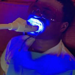 Summerville Cosmetic Teeth Whitening - DURING SINGLE TREATMENT