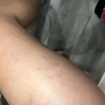 DESUAR Hollywood Spa - Bruise after the treatment - Massage Near Me - Los Angeles, California DESUAR Hollywood Spa - Bruise after the treatment - Massage Near Me - Los Angeles, California