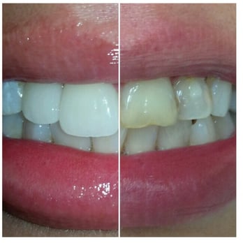 Toothopia Dental - Before and After - General Dentistry Near Me - El Segundo, California Toothopia Dental - Before and After - General Dentistry Near Me - El Segundo, California