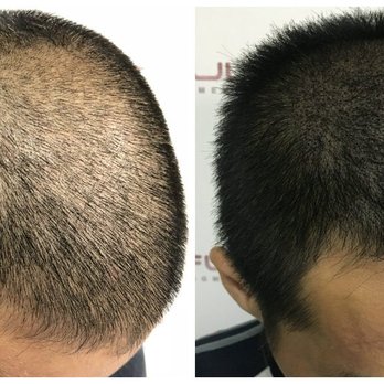 Full Micropigmentation - Hair Loss Centers Near Me - Newport Beach, California
