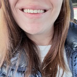 Ford Dental - Front teeth composite bonding