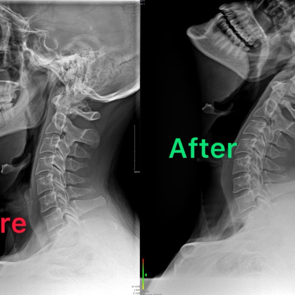 Lee Chiropractic - Before and after pics of my neck X-rays - Chiropractors Near Me - Irvine, California Lee Chiropractic - Before and after pics of my neck X-rays - Chiropractors Near Me - Irvine, California