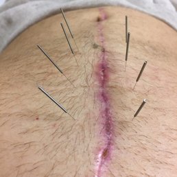 Less than three weeks after surgery, Dr. Kong has brought me from moderate pain to zero pain almost instantaneously:)
