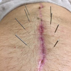 Shan Kong Acupuncture - Less than three weeks after surgery, Dr. Kong has brought me from moderate pain to zero pain almost instantaneously:)