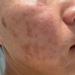 I A M Clinic - Skin Damage