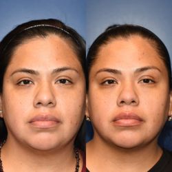 K Kay Durairaj, MD - Instant lift with facial and my skin feel so good .