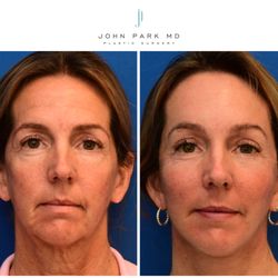 John Park MD Plastic Surgery - Facelift/Necklift, Endoscopic Brow LIft, Facial Fat Grafting, Control Depth Peel