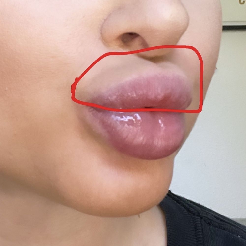 Steven K Struck, MD - Filler migration/ placement far above the top lip - Cosmetic Surgeons Near Me - Atherton, California Steven K Struck, MD - Filler migration/ placement far above the top lip - Cosmetic Surgeons Near Me - Atherton, California