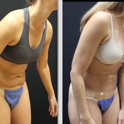 Advanced Image Med Spa & Wellness Center - Renuvion skin tightening