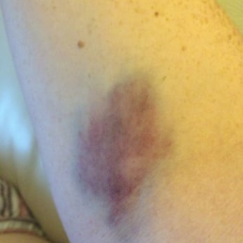 Quest Diagnostics - Pretty sure your arm shouldn't look like this the day after.... - Laboratory Testing Near Me - Long Beach, California Quest Diagnostics - Pretty sure your arm shouldn't look like this the day after.... - Laboratory Testing Near Me - Long Beach, California
