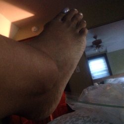 Patient First Primary & Urgent Care - Wyomissing - Broken ankle