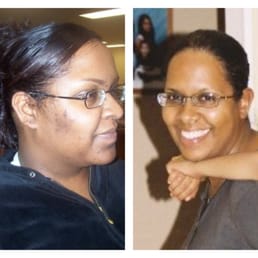 Over a 6month period. Consistency with Spela saved my skin! Over a 6month period. Consistency with Spela saved my skin!