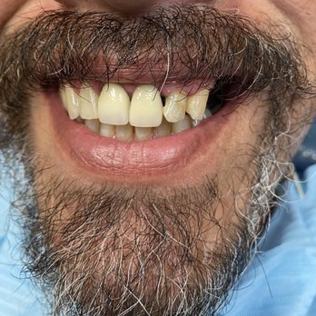 Victor De Los Santos, DDS - Before - General Dentistry Near Me - Los Angeles, California Victor De Los Santos, DDS - Before - General Dentistry Near Me - Los Angeles, California