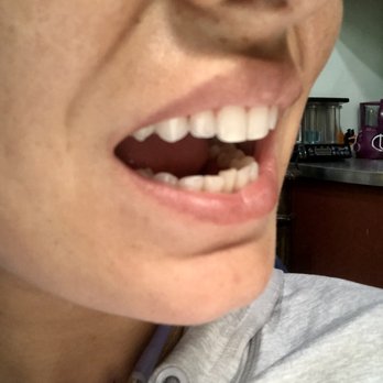 Fillmore Dental Spa - After Shaving Side - General Dentistry Near Me - San Francisco, California