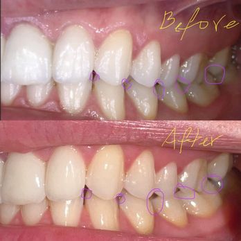 Inspired Dental - Teeth after don't have enough touching surface as before, they are shorter, weird shapes, bite has changed - General Dentistry Near Me - Las Vegas, Nevada Inspired Dental - Teeth after don't have enough touching surface as before, they are shorter, weird shapes, bite has changed - General Dentistry Near Me - Las Vegas, Nevada