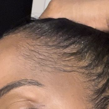 Destiny Hair Studio - The right side of my hairline before the sew in. No BALD SPOT! - Hair Salons Near Me - Bronx, New York Destiny Hair Studio - The right side of my hairline before the sew in. No BALD SPOT! - Hair Salons Near Me - Bronx, New York