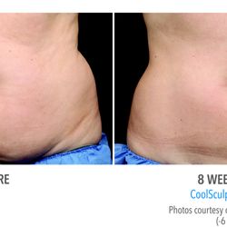 COSMETIC LASER CENTERS - Check out these amazing Coolsculpting results!