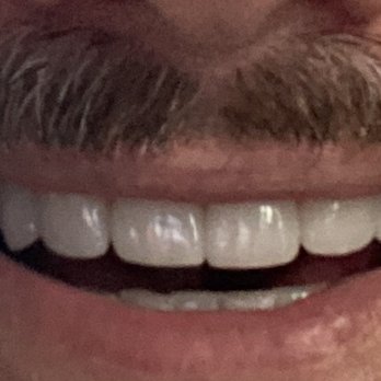 Mehrdad Makhani, DDS - 6 upper vangers. So glad I did 6 instead of 4. - General Dentistry Near Me - Los Angeles, California