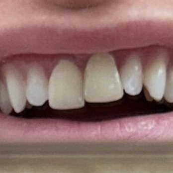Dublin Modern Dentistry - The two veneers they put on. - General Dentistry Near Me - Colorado Springs, Colorado