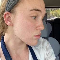 ASerenity Skin Body - After acne treatment!