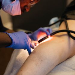 Coastal Vein Care - Sclerotherapy Session