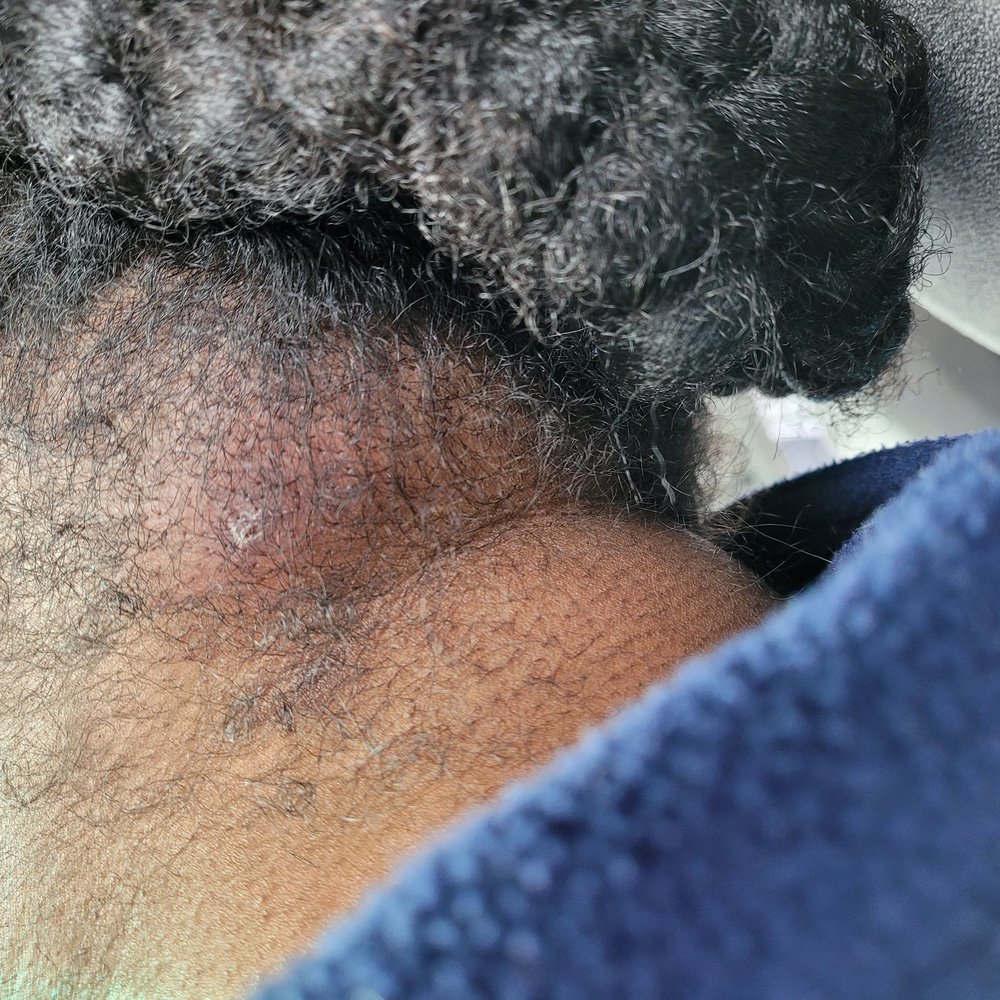 Mary's African Hair Braiding - Cellulitis infection after braids in for 2 weeks - Hair Salons Near Me - Plainfield, New Jersey Mary's African Hair Braiding - Cellulitis infection after braids in for 2 weeks - Hair Salons Near Me - Plainfield, New Jersey