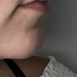 Before fillers. Before fillers.