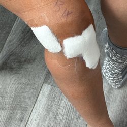 St Charles Mercy Hospital - ACL reconstruction & meniscus repair with guaze