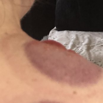 Khloe Wilson, LMT - Tranquility Life - Side view of the shoulder blisters - Massage Near Me - Crystal Lake, Illinois Khloe Wilson, LMT - Tranquility Life - Side view of the shoulder blisters - Massage Near Me - Crystal Lake, Illinois