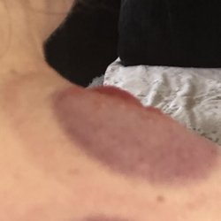 Side view of the shoulder blisters