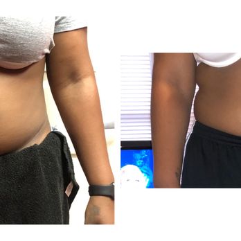 Bodied by E - Body Contouring Near Me Bodied by E - Body Contouring Near Me