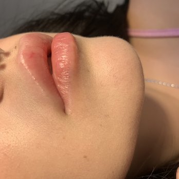 Venus Med Spa - Riverview - Lip filler - Medical Spas Near Me - Riverview, Florida Venus Med Spa - Riverview - Lip filler - Medical Spas Near Me - Riverview, Florida