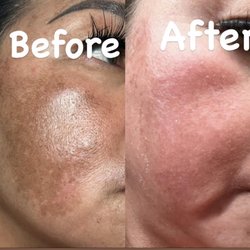 The Perfect Skin - Melasma progress