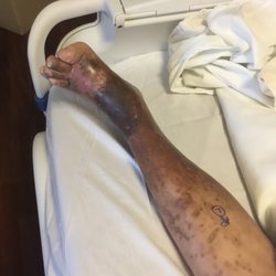 Blessing Hospital Wound Healing & Hyperbaric Center - My husband's leg just prior to the below the knee amputation the result of BWC's failure to treat a bone infection for approximately 2 yrs.
