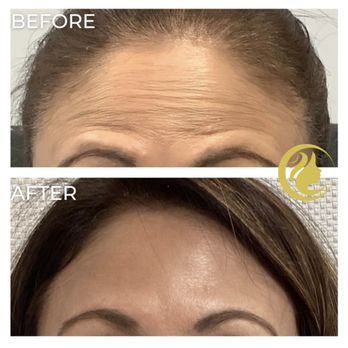 Aesthetica MedSpa - Botox before and after - Medical Spas Near Me - Paramus, New Jersey Aesthetica MedSpa - Botox before and after - Medical Spas Near Me - Paramus, New Jersey