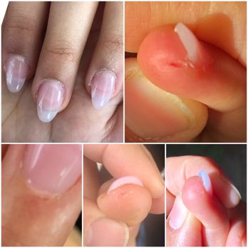 Elite Nails & Spa - Cuts and awful looking acrylic set - Nail Salons Near Me - Roy, Utah Elite Nails & Spa - Cuts and awful looking acrylic set - Nail Salons Near Me - Roy, Utah