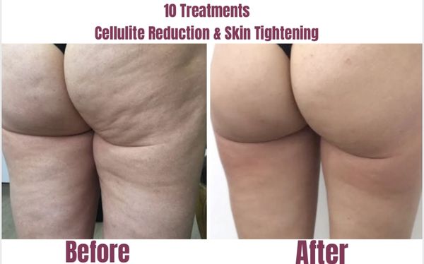 Project Cheer: We’re in the spirit of giving, this holiday. So we’re offering huge discounts on our skin and body treatments! - Body contouring, skin tightening, skin resurfacing, scar removal, acne and acne scars, skin lightening and facials.