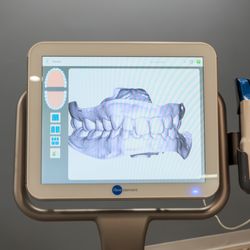 Quest Orthodontics - Atlanta - No Goop No Gag Digital Impressions