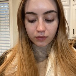 Before rhinoplasty
