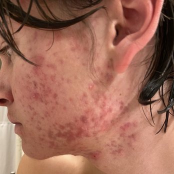 Acne Solutions Skin Care & Spa - The journey - Acne Treatment Near Me - Upland, California