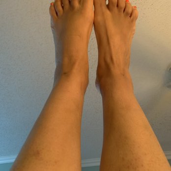 David Amron, MD - ankles and calves healing and pain-free - Dermatologists Near Me - Beverly Hills, California David Amron, MD - ankles and calves healing and pain-free - Dermatologists Near Me - Beverly Hills, California