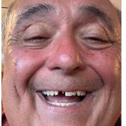 Smile Design Dental of Coral Springs - Getting my full smile back at SMILE DESIGN DENTAL MARGATE
