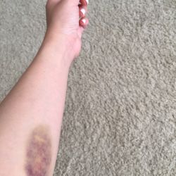 Quest Diagnostics - OUCHH.............7 pokes and 1 bruise.